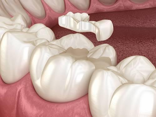Tooth Onlay in Hampton VIC