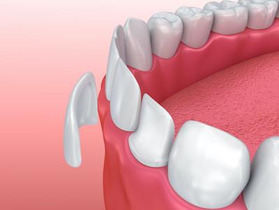 veneers hampton