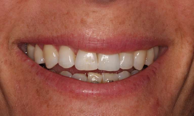 Implant-after-Tooth-Alignment-with-Braces-After-Image