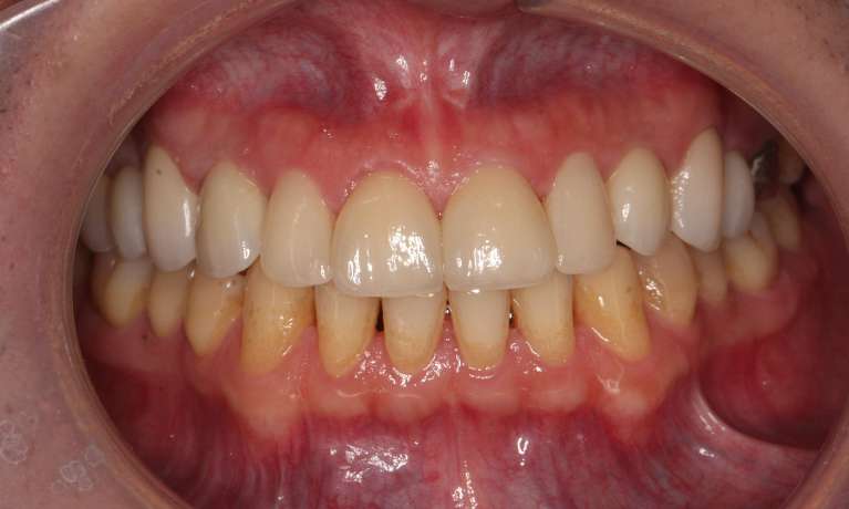 dental implants in fairfield vic