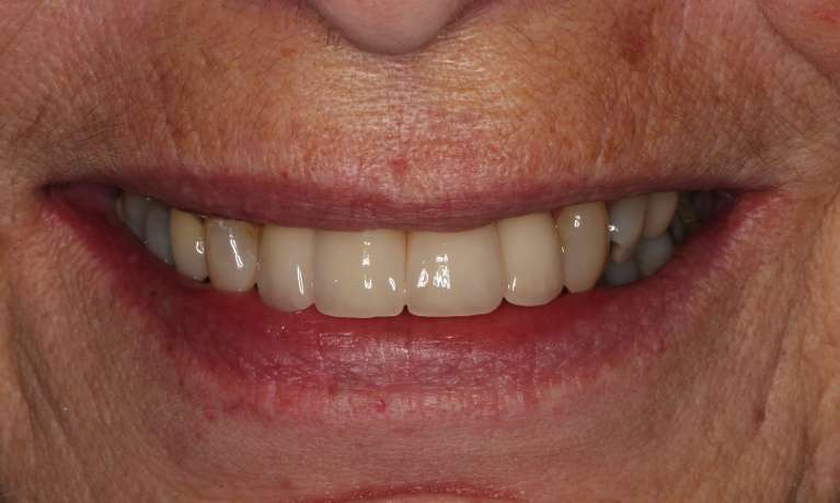 Extraction and Crown and Bridge treatment photos in Hampton VIC