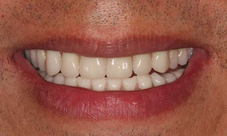 Implant-supported-Dentures-After-Image