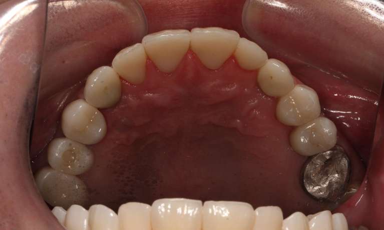 dental crowns in fairfield vic