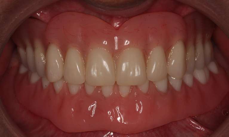 Implant supported dentures in Fairfield VIC