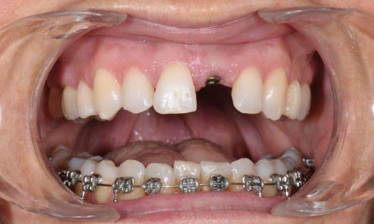 Implant-after-Tooth-Alignment-with-Braces-Before-Image