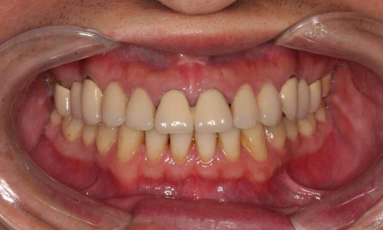 implant supported crowns in hampton vic