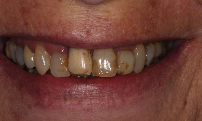 Extraction and Crown and Bridge treatment photos in Hampton VIC