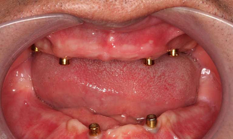 Implant-supported-Dentures-Before-Image