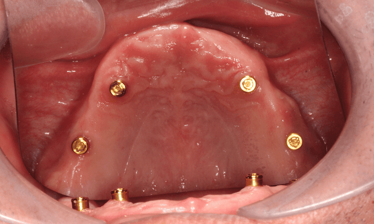 Implant supported dentures in Fairfield VIC